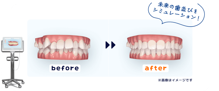 歯並び before after