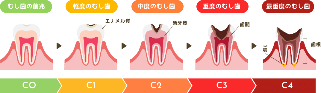 むし歯の進行と治療のイメージ