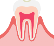 CO：むし歯になりかけの歯のイメージ