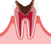 C3：神経まで達したむし歯のイメージ