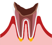 C4：末期のむし歯のイメージ