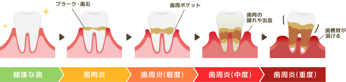 歯周病の進行と治療のイメージ