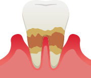 中度歯周炎のイメージ
