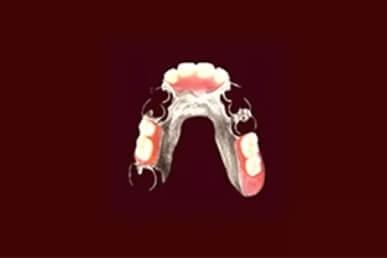 コバルトクロム床義歯のイメージ