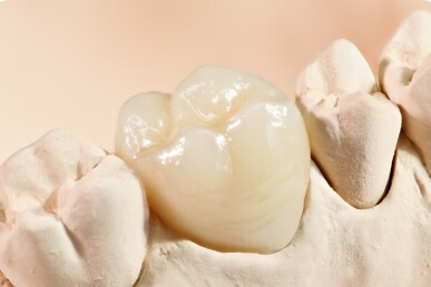 CADCAM冠のイメージ