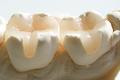 セラミックインレーのイメージ