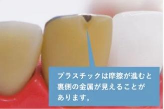 前歯の被せ物(クラウン)耐久性のイメージ