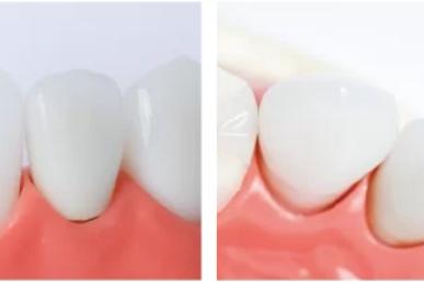 前歯のオールセラミックのイメージ