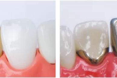前歯のメタルセラミックのイメージ