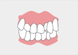 八重歯の状態